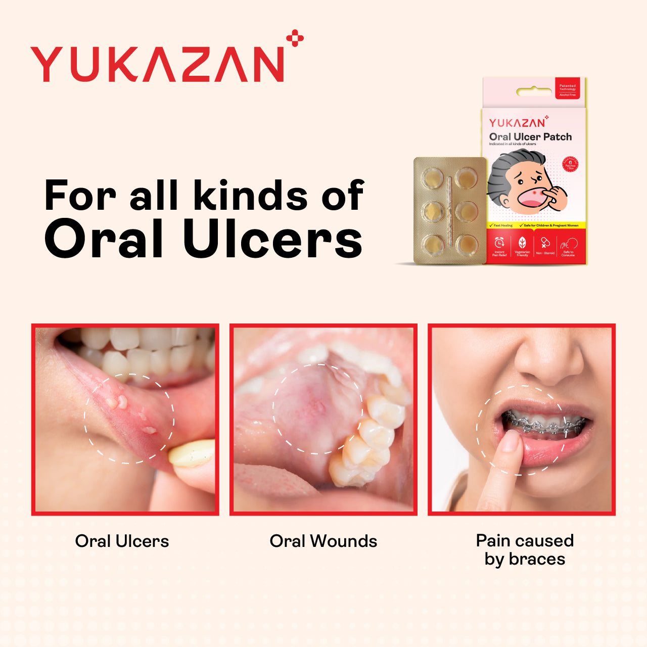 Yukazan Oral Ulcer Patch (6 pieces) - For all kind of oral & canker ulcers