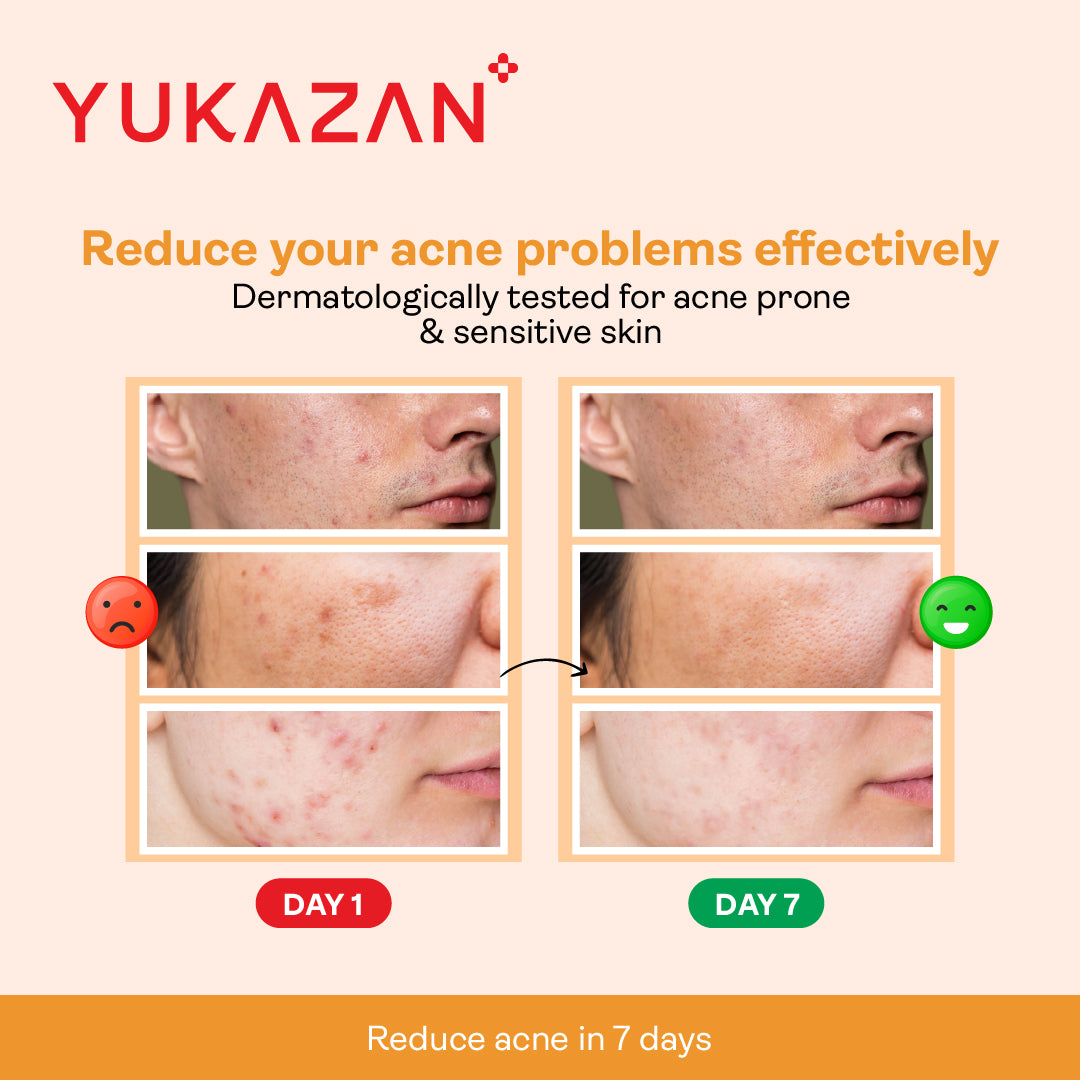 Yukazan Derma Refining Cream Acne & Pore 5ml Acne Removal Cream - Reduce acne in 7 days